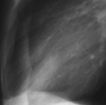Primary Pulmonary TB Radiograph Ghon focus