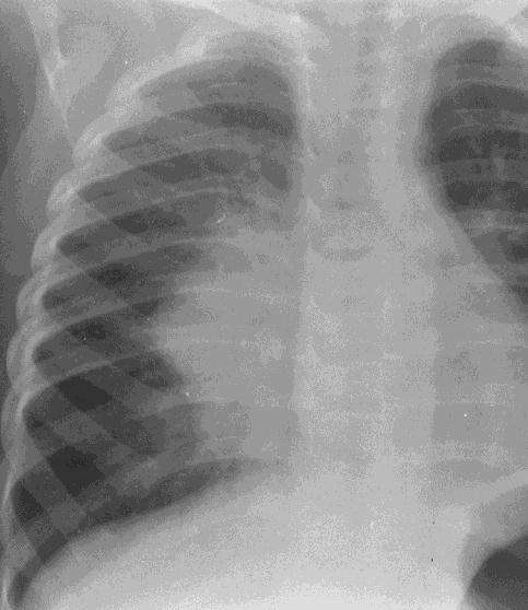Cavities Disseminated Pulmonary TB Miliary