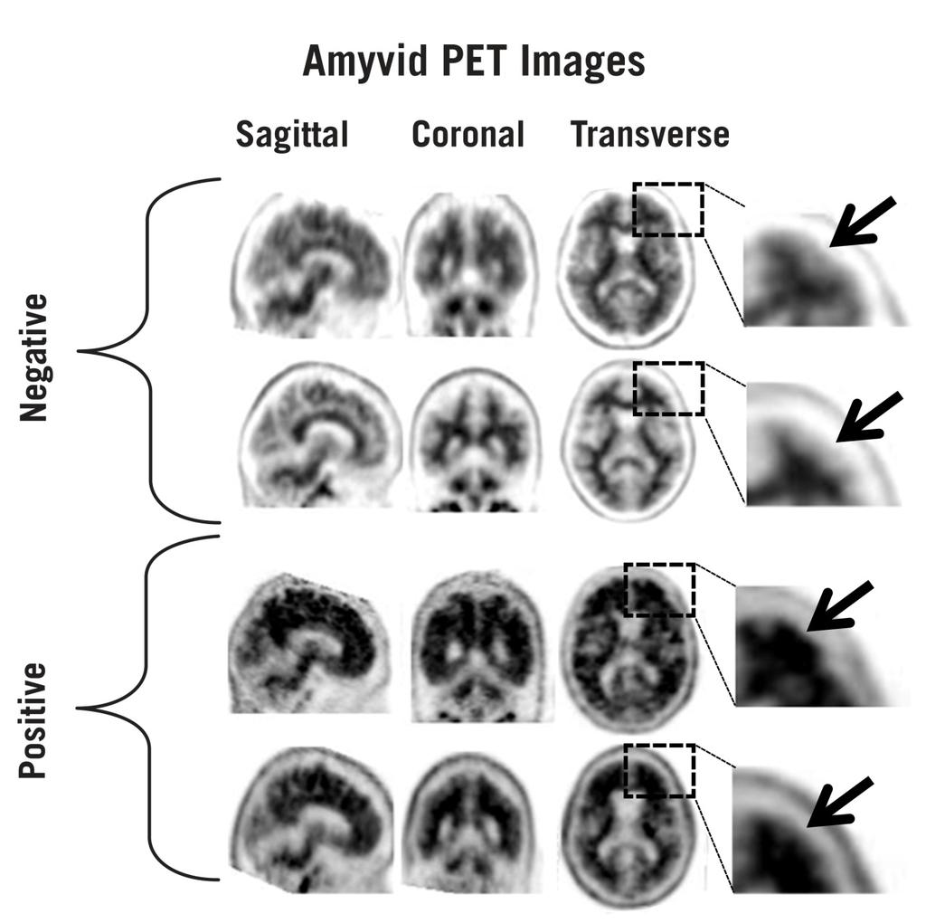 Figure 1: Amyvid PET cases showing examples of negative scans (top two rows) and positive scans (bottom two rows). Left to right panels show sagittal, coronal, and transverse PET image slices.
