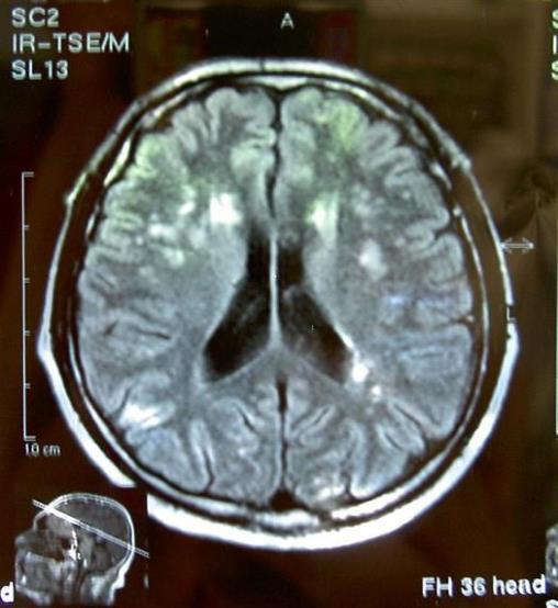 Brain MRI, T2 sequence: multiple cortical and subcortical infracts in a vascular dementia