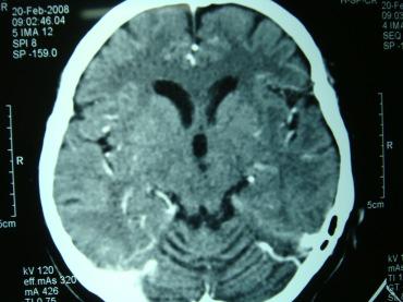 B. Circumscribed cerebral atrophy 1. Pick disease (lobar sclerosis) 2. Mesolimbocortical dementia of non- Alzheimer type 3.