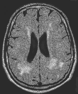 VaD and AD PET scan in Vascular