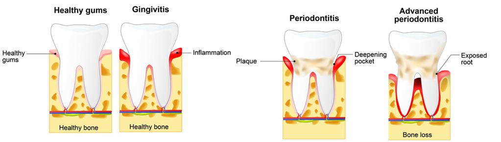 Q. What treatments are needed? A. Your dental team will remove all plaque and tartar from your teeth.