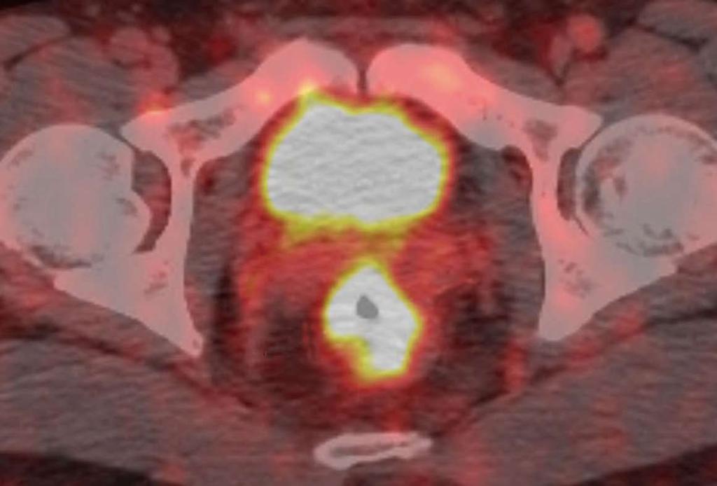 shows a T3 tumor (arrows) with the restricted diffusion and intense hyper-metabolism; D-F: After CRT, T2-weighted MRI (D) shows a marked decrease in the tumor size.