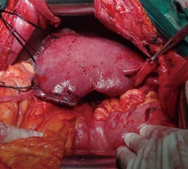 Jia CK et al. Anatomic segmentectomy for HCC A B 7 8 6 Figure 3 Surgical results. A: After hepatectomy, the inflow and outflow of segment 5 were maintained.