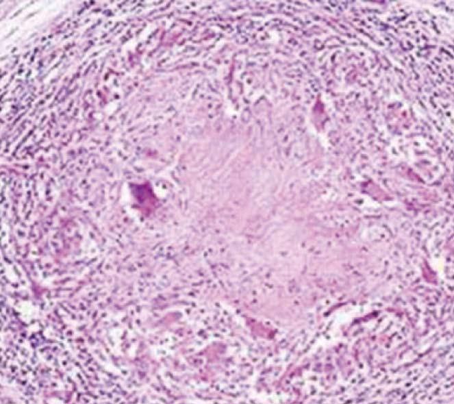 ring-like ulcer and intestinal stricture in the ileocecum; D: Microscopic findings showed granulomas with caseous necrosis (hematoxylin and eosin staining; original magnification, 400 ).