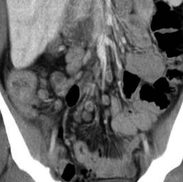 contrast-enhanced CT scan demonstrated moderate homogeneous enhancement; C: Mesenteric necrotic lymph nodes and comb sign were