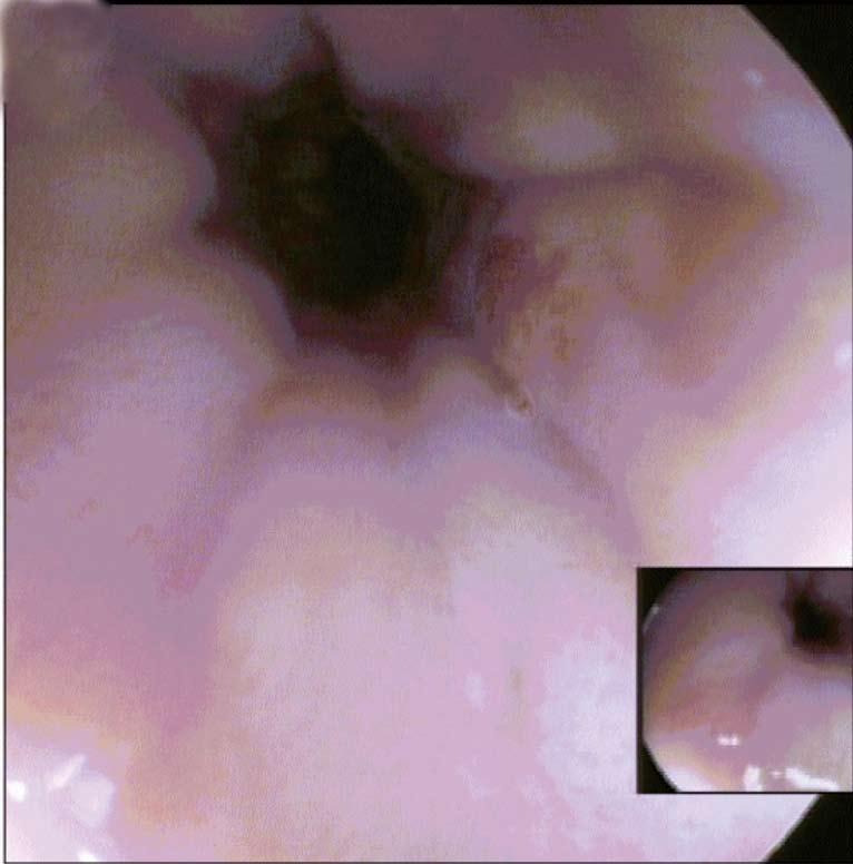 This demonstrates high grade dysplasia with nuclear pleiomorphism, increased nuclear: cytoplasmic ratio and disordered nuclei (arrow); C: Endoscopic view of the patient s columnar-lined oesophagus