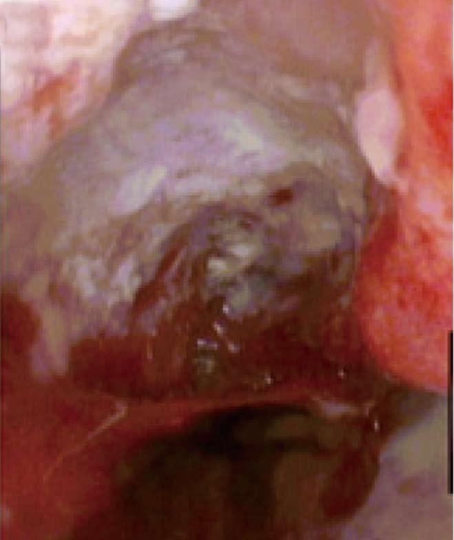Zeki SS et al. SCC after RFA for Barrett s oesophagus A B D T G C G T * C T G C G T Figure 2 Endoscopic, genetic and histological figures of the patient after radiofrequency ablation.