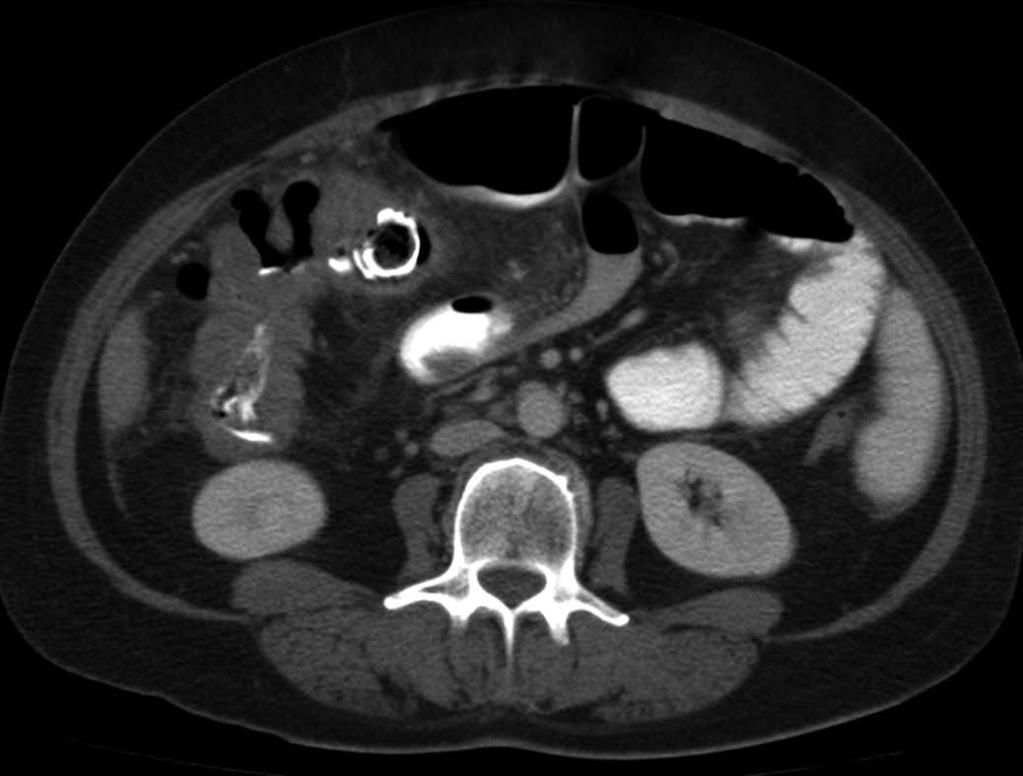 Camera L et al. Colonic perforation by a retained sponge A B C D * * Figure 1 Multi-detector contrast-enhanced computed tomography. Transverse images of the lower abdomen are shown (A-D).