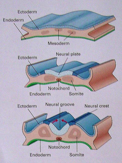 Spinal Lipoma Premature disjunction of cutaneous ectoderm from neuroectoderm allows mesenchyme to contact inner portion of neural tube.