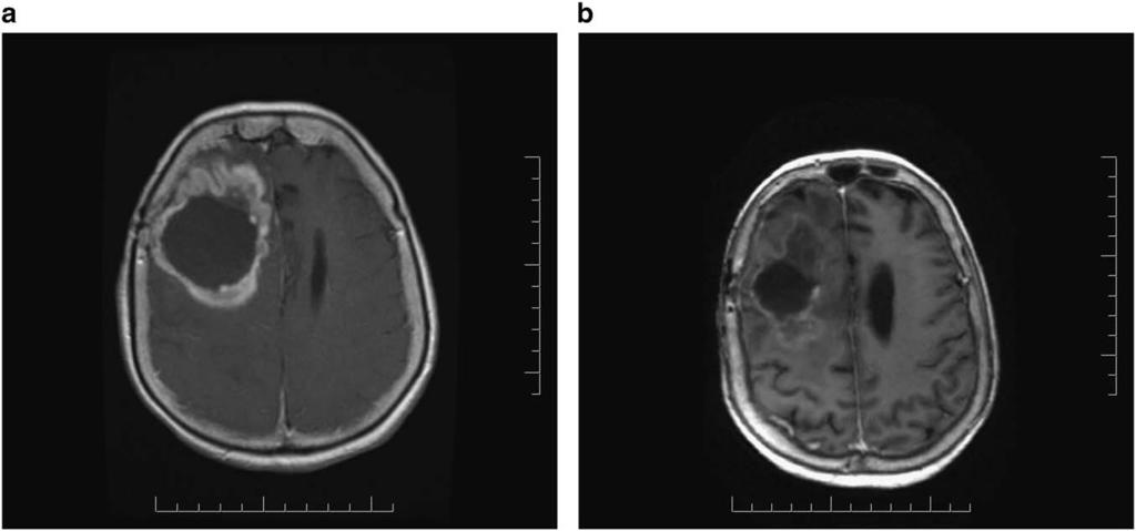 LE JOURNAL CANADIEN DES SCIENCES NEUROLOGIQUES Figure 1: (a) Contrast-enhanced axial T1-weighted MR scan reveals considerable tumour progression and surrounding edema following a second resection for