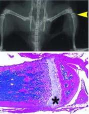 Increased Bone Density Associated With