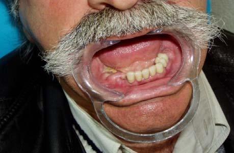 Factors: Invasive dental procedures (eg, tooth