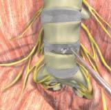 The lumbar spine is exposed via a retroperitoneal or transperitoneal approach based on the vertebral level(s) to be treated, individual patient anatomy and pathology, and surgeon preference.