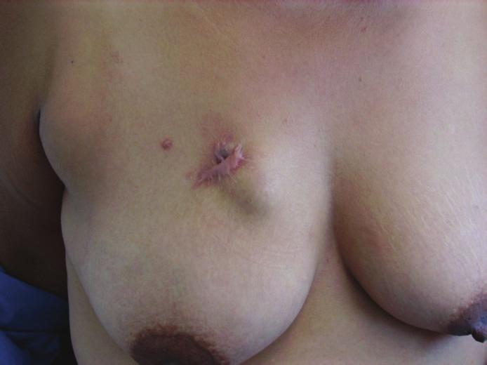 2 Case Reports in Oncological Medicine Figure 1: Photography of recurrent tumor in the right breast beneath the previous site of resection. Note the nodule under the scar deforming the overlying skin.