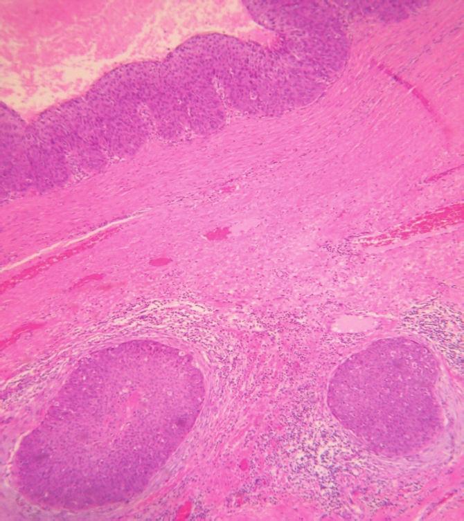 Case Reports in Oncological Medicine 3 Figure 5: Photomicrograph showing epithelial cell nests in the stroma with desmoplastic reaction (H and E, 10).