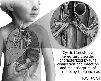 Cystic Fibrosis: Summary Give a brief introduction to the disease, considering the following: the symptoms that define the syndrome, the range of phenotypes exhibited by individuals with the