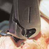 Bring the outer barrel of the caliper into contact with the dorsal surface of the metatarsal, and take the measurement.