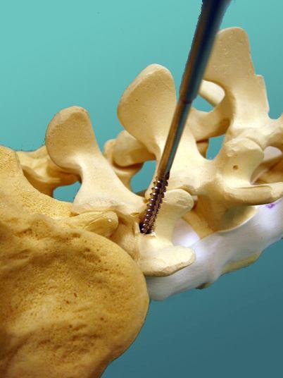 walls as well as the bottom of the hole through the pedicle and into the vertebral body. Step 4.