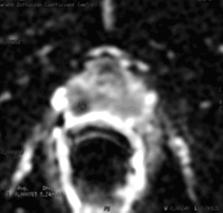 However, the apparent diffusion coefficient (ADC) map (b) shows a clear focal lesion with low signal intensity in the right peripheral zone, within the sextant that was biopsy-positive for tumor.