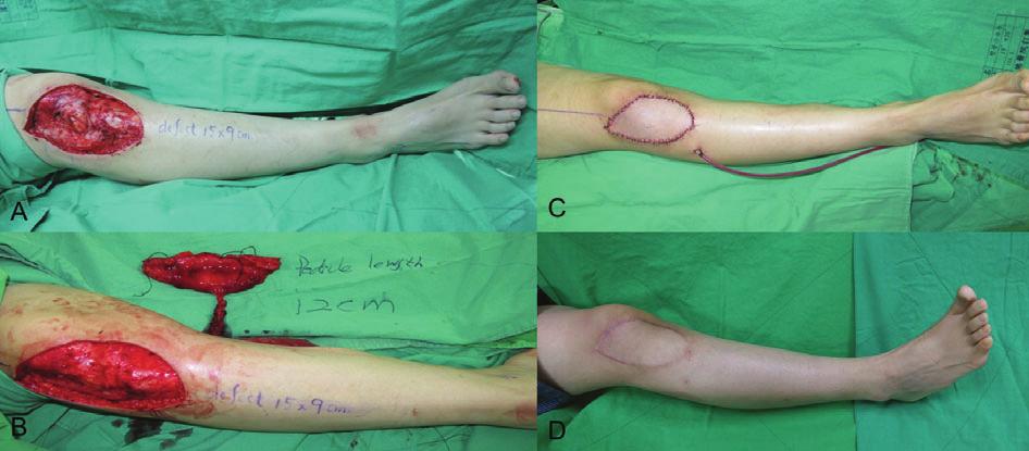 Pedicled medial sural perforator flap for the reconstruction of knee defects I.-H. Chiang et al. Figure 4 (A) A 43-year-old woman exhibited sarcoma on the lateral aspect of the right knee.