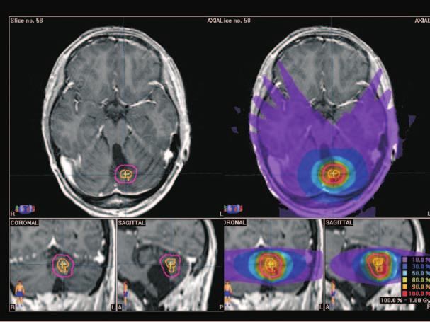 Figure 2. High precision radiotherapy using stereotactic system. Example of hypofractionated stereotactic radiotherapy as a rescue after small relapse of glioblastoma multiforme.