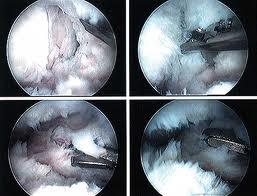 Fusion Microdiscectomy, Medial Branch Block, Radiofrequency Ablation