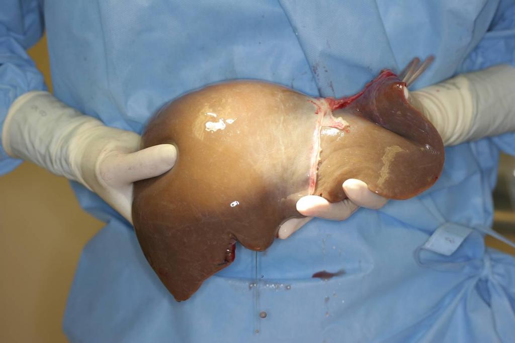 Orthotopic Liver Transplantation (OLTX) Clinical Criteria: Age 60 yrs Dx duration 5 yrs PN restricted to LEs OR