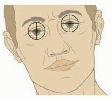 TROCHLEAR (IV) NERVE DAMAGE: INABILITY TO TURN EYE DOWN AND OUT; ALSO HEAD TILT NORMAL HEAD EYE EYE