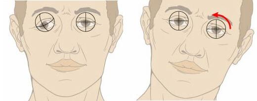occurs when tilt head; rotate ipsilateral eye medially when tilt head laterally X HEAD AFTER IV DAMAGE