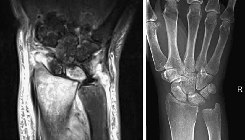 592 L. VAnDEnBERghE, J. StUyCk, I. DEgREEf, L. DE SMEt fig. 2. Case 2. MRI image of osteomyelitis of distal radius and lunatum. Radiographs show joint space narrowing and subluxation of the lunatum.