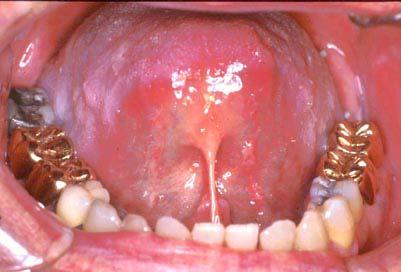 D13 Same patient trying to elevate tongue as high as