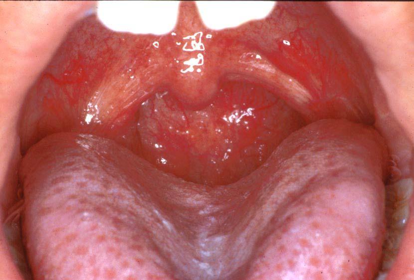 Twelve-year-old with massive tonsils.