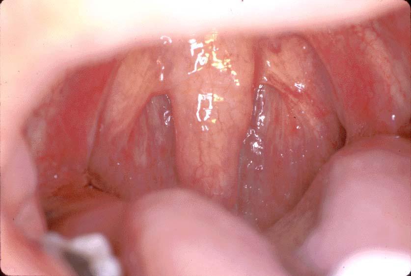 Adult with massive uvula that can