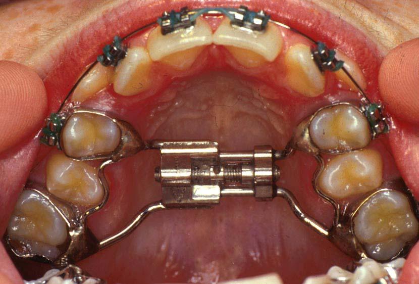 Examples of fixed rapid palatal expanders (RPE). RPE MUST be done before the mid-palatal suture fuses.