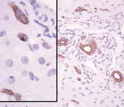 Goldstein et al / DISTINGUISHING PRIMARY BILIARY CIRRHOSIS FROM AUTOIMMUNE HEPATITIS (75%) of 16 PBC biopsy specimens had cytokeratin 7 reactive periportal hepatocytes.