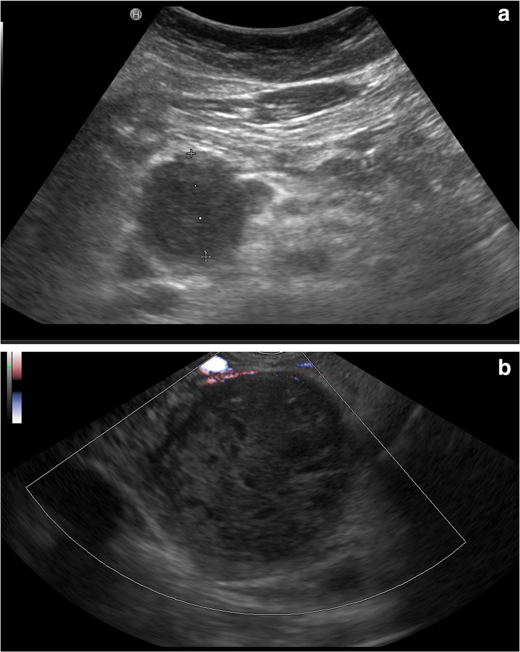 Bidassek et al. Diagnostic Pathology (2016) 11:7 Page 2 of 5 Fig. 1 Findings from ultrasound sonography. a trans abdominal ultrasound sonography showing a mass in the pancreatic caput.