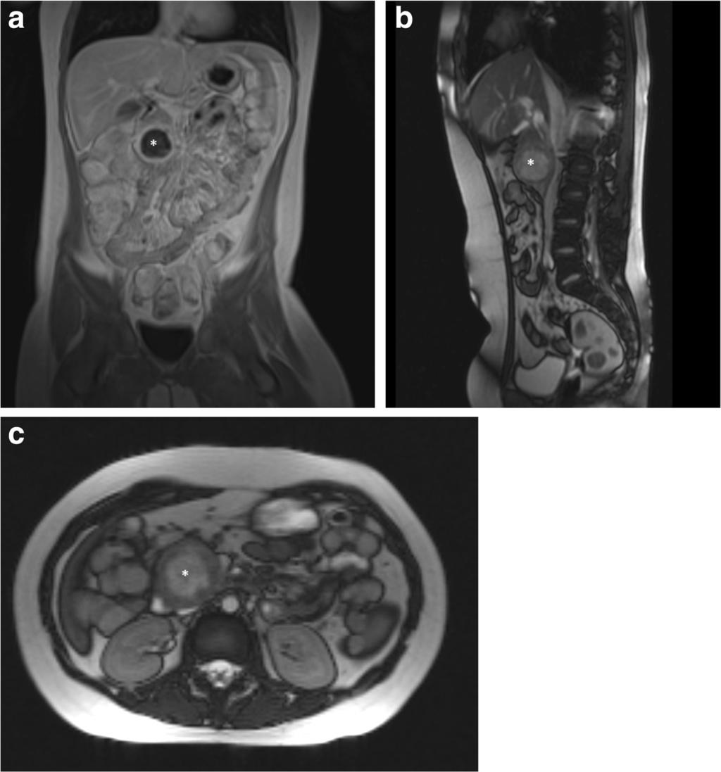 Bidassek et al. Diagnostic Pathology (2016) 11:7 Page 3 of 5 Fig. 2 MRI scans in coronary. * SPN.