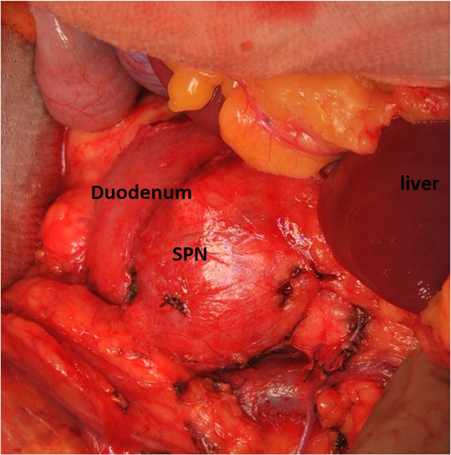 On like in other reports, signs of gastric outlet obstruction, i.e. mechanical obstruction of the upper gastrointestinal tract with recurrent bitter vomitus in this case heralded SPN.