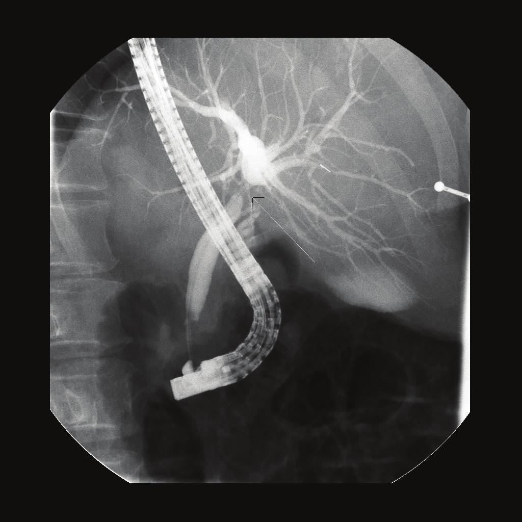 ducts) over temporary externalized 5 French stents. No blood products were required, and no inflow occlusion was used.