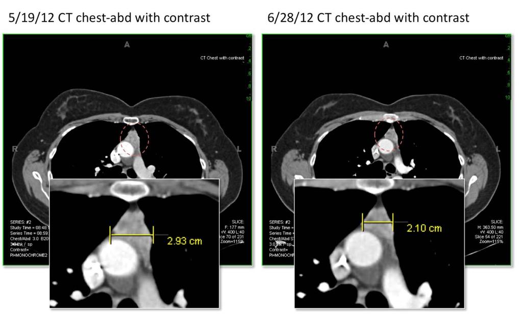 Case Study: Patient treated with imatinib Tumor response seen in one month post treatment CT Disease has