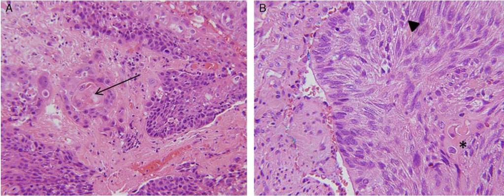 When used merely as a sequencing method, NGS has diagnostic utility 63 yo woman with prior history of oropharyngeal SCC, now with new lung SCC Nonsynonymous, Nonpolymorphic Variants Identified by