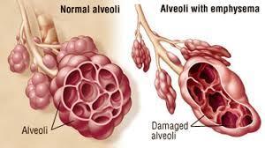 Alveoli and Smoking Smoking can damage the alveoli.