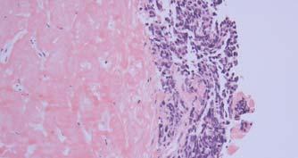 Small Cell Malignant tumors -
