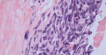 small cell carcinoma Carcinoids