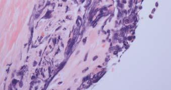 Squamous Ca Large cell CA