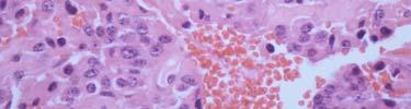 germ cell tumors,