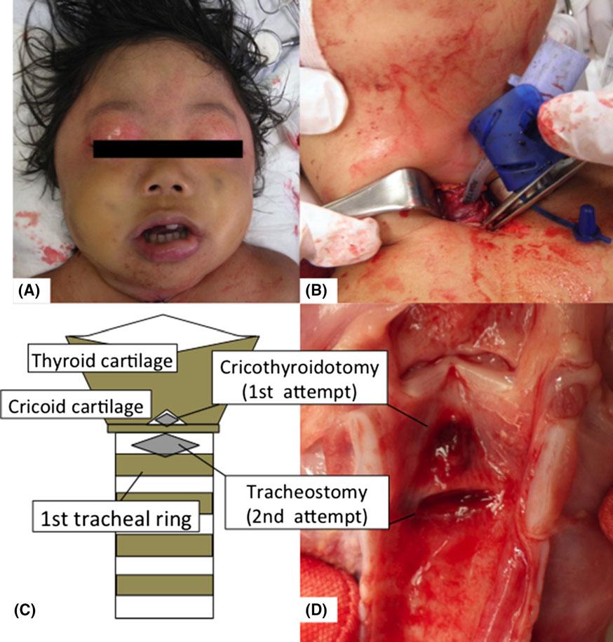 Acute Medicine & Surgery 2017; 4: 462 466 Management of pediatric CICO 463 Fig. 1. Pediatric case of cannot intubate, cannot oxygenate. A, Extreme swelling of the lip, tongue, and lower jaw.