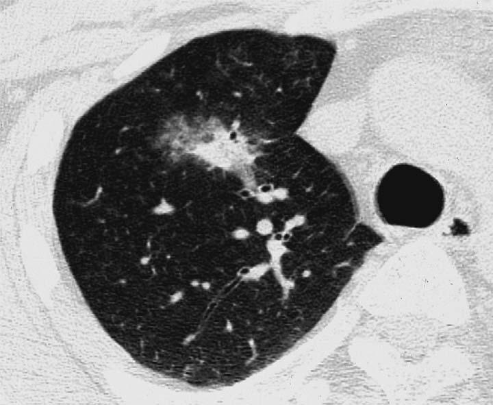 patient developed bloody sputum, and chest CT revealed patchy consolidation in the right upper lobe (Fig. 3), which disappeared of its own accord.